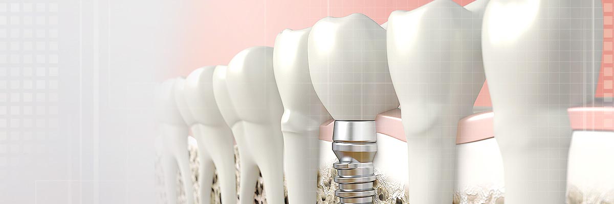 Mission Viejo Implant Dentist