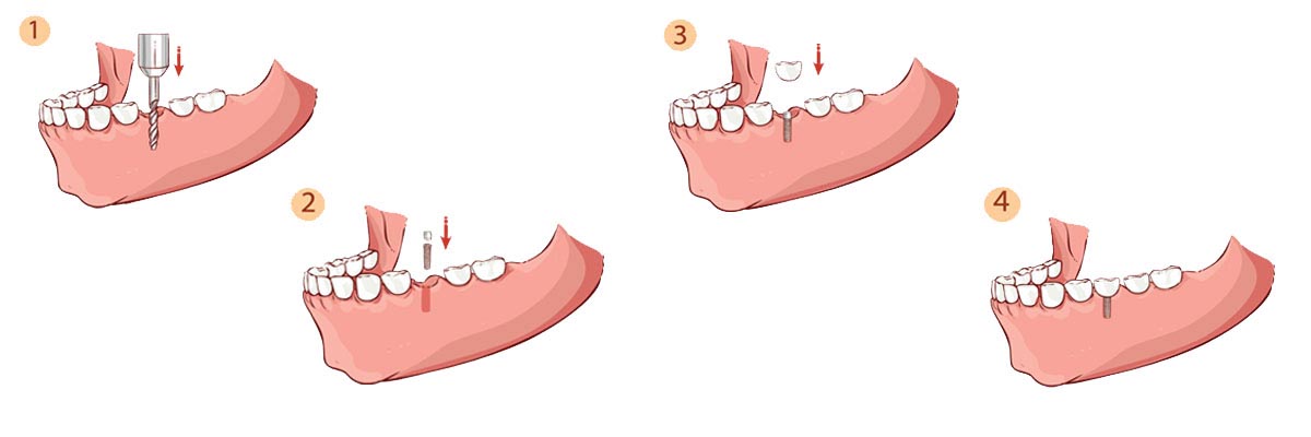 Mission Viejo The Dental Implant Procedure