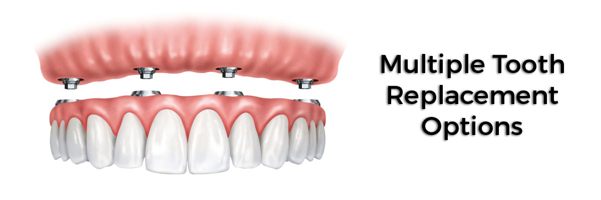 Mission Viejo Multiple Teeth Replacement Options